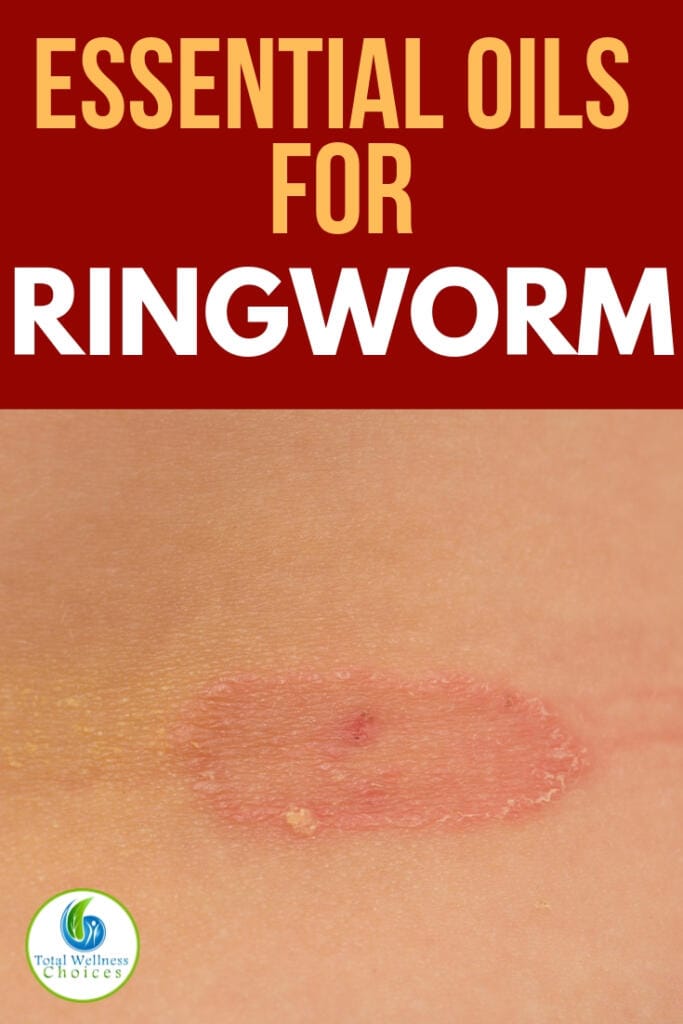 7 Best Essential Oils for Ringworm - Antifungal EOs that Kill the Fungus!